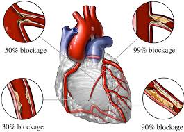 Heart Blockage Treatment at Livasa Mohali - Surgical & Medical Options